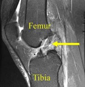 Femur & Tibia - Xray